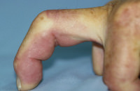 Foto von Dr. Gabl: Ein gekr¨mmter Finger